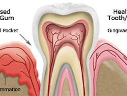 Gum Disease